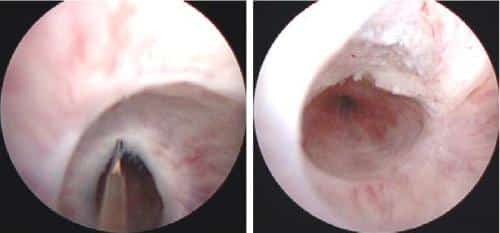 internal üretrotomi