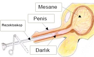 kapalı üretra darlığı ameliyatı