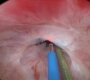uretra darligi ameliyati 1 90x80